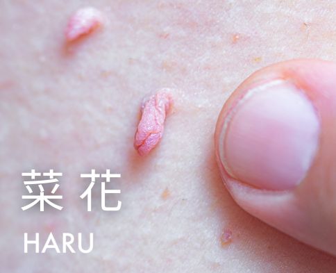 菜花是什麼 如何預防得性病